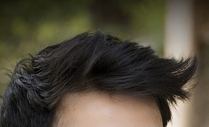 Which hair transplant is better — FUT Or FUE?