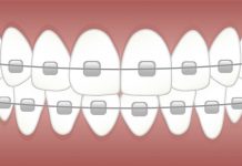 Common Problems Faced After Braces Application