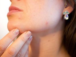 How Does the Singapore Climate Make Acne Worse and What Can You Do? acne, pores, skin, pimple, female, face, skincare, infection, treatment, disease, dermatology, facial, person, hygiene, painful, scar, irritation, young, bacteria, pus, caucasian, eruption, sebaceous, blackhead, complexion, hormone, girl, woman, lady, party killer, crisis, emergency, blemish, problems, cheek, sore, cosmetic, adult, spots, products, health, care, problematic, killjoy, inconvenient, timing, party, hacks, chick, epidermis, help, zit, bothersome, annoying, outbreak, makeup, non-comedogenic, foundation, color, tone, undertone, medical, puberty, acne, acne, acne, acne, acne, pimple