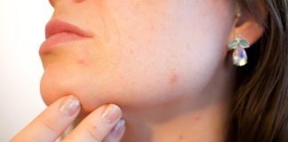 How Does the Singapore Climate Make Acne Worse and What Can You Do? acne, pores, skin, pimple, female, face, skincare, infection, treatment, disease, dermatology, facial, person, hygiene, painful, scar, irritation, young, bacteria, pus, caucasian, eruption, sebaceous, blackhead, complexion, hormone, girl, woman, lady, party killer, crisis, emergency, blemish, problems, cheek, sore, cosmetic, adult, spots, products, health, care, problematic, killjoy, inconvenient, timing, party, hacks, chick, epidermis, help, zit, bothersome, annoying, outbreak, makeup, non-comedogenic, foundation, color, tone, undertone, medical, puberty, acne, acne, acne, acne, acne, pimple