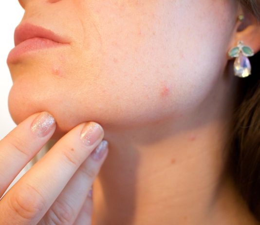 How Does the Singapore Climate Make Acne Worse and What Can You Do? acne, pores, skin, pimple, female, face, skincare, infection, treatment, disease, dermatology, facial, person, hygiene, painful, scar, irritation, young, bacteria, pus, caucasian, eruption, sebaceous, blackhead, complexion, hormone, girl, woman, lady, party killer, crisis, emergency, blemish, problems, cheek, sore, cosmetic, adult, spots, products, health, care, problematic, killjoy, inconvenient, timing, party, hacks, chick, epidermis, help, zit, bothersome, annoying, outbreak, makeup, non-comedogenic, foundation, color, tone, undertone, medical, puberty, acne, acne, acne, acne, acne, pimple