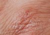 What’s the Best Way to Treat Psoriasis That Keeps Coming Back? Detailed image highlighting dry, flaky skin texture for dermatological study.