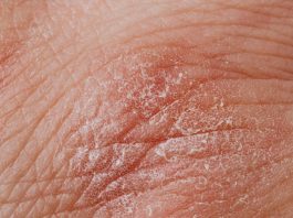 What’s the Best Way to Treat Psoriasis That Keeps Coming Back? Detailed image highlighting dry, flaky skin texture for dermatological study.