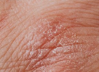 What’s the Best Way to Treat Psoriasis That Keeps Coming Back? Detailed image highlighting dry, flaky skin texture for dermatological study.